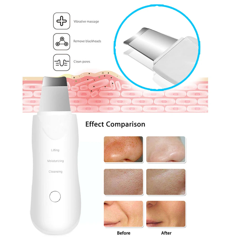 Ultrasonic Skin Scrubber Scrubber Deep Vibrate Facial Cleaner Ultraschall Gesichtsreinigungsgerät - Tiefenreinigung und Hautpflege